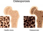 Manfaat MELIA PROPOLIS Untuk OSTEOPOROSIS Pengeroposan Tulang